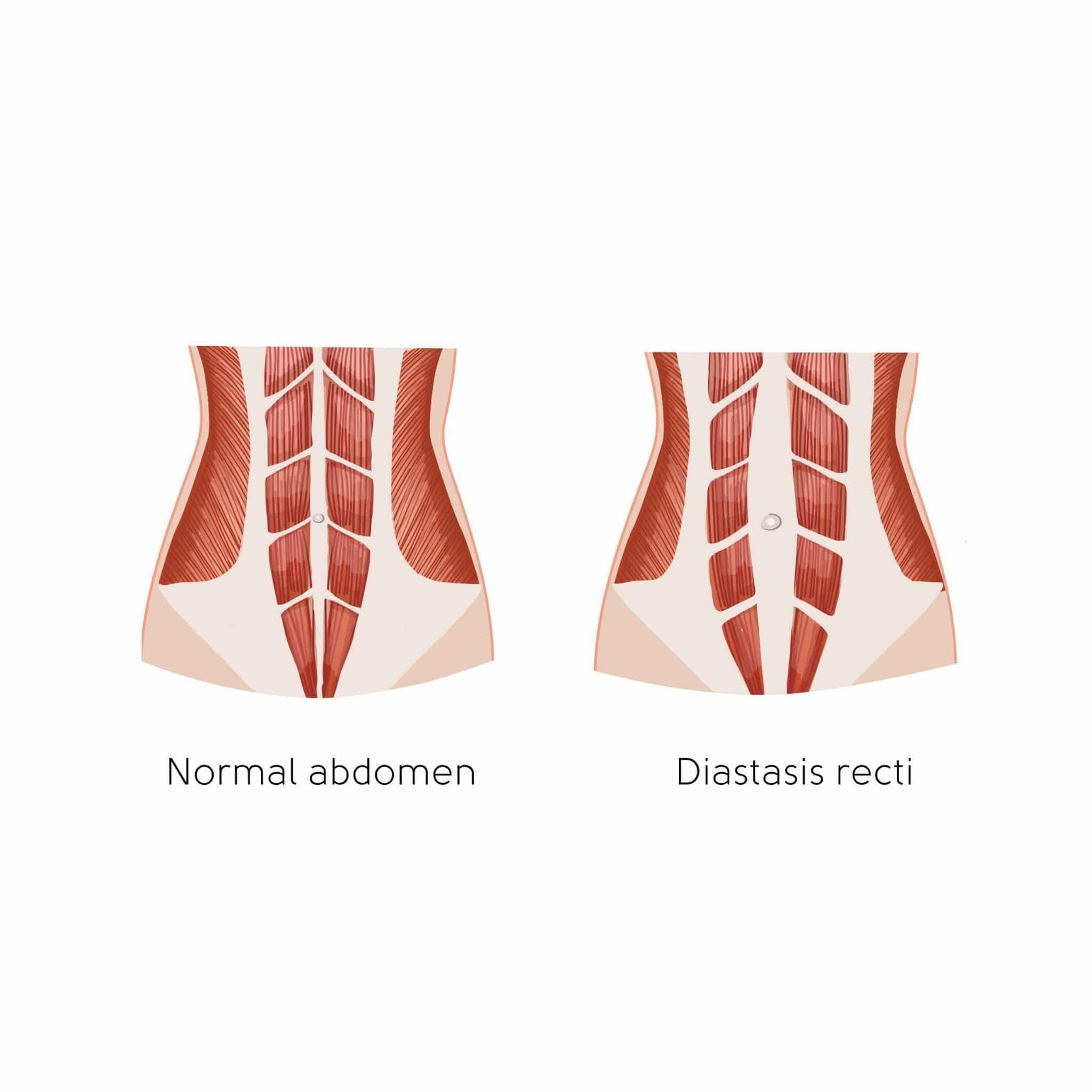 Diastasis Recti Cases & Photo Guide – Postpartum Girdles