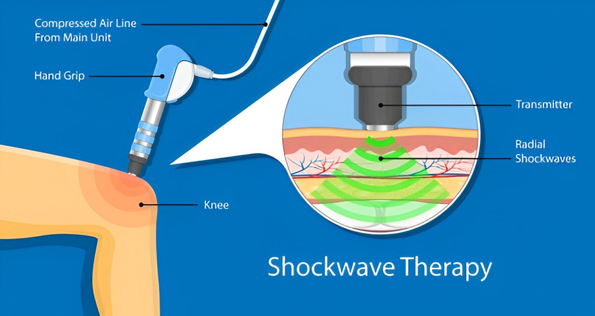 Shockwave Therapy Explain With Image