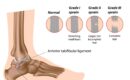 Ankle Sprain Physiotherapy