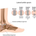 Ankle Sprain Physiotherapy