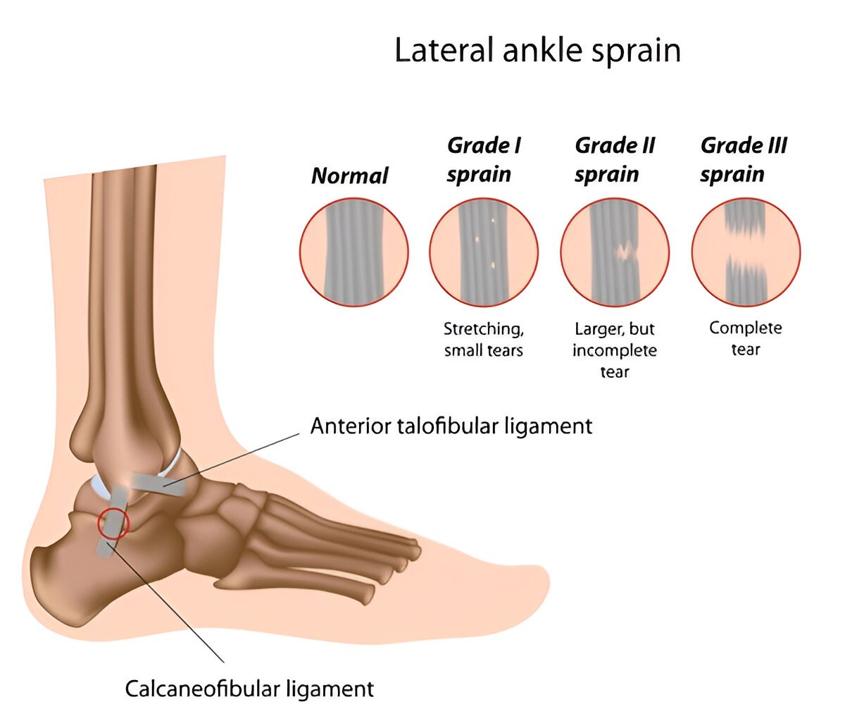 Ankle Sprain Physiotherapy