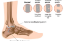 Types of Ankle Sprain grade 1,2 & 3