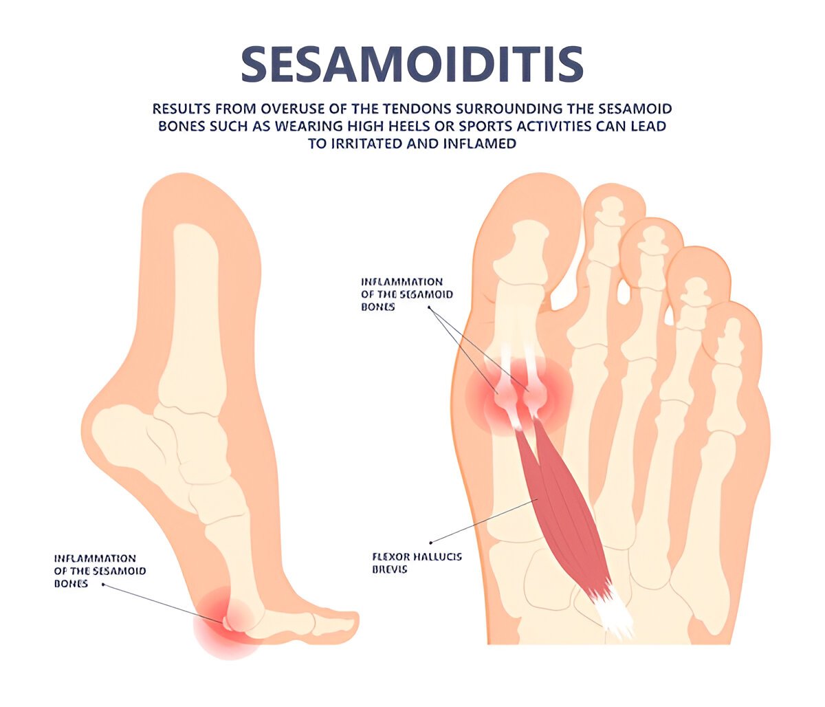 sesamoiditis in the foot, showing inflammation of the sesamoid bones