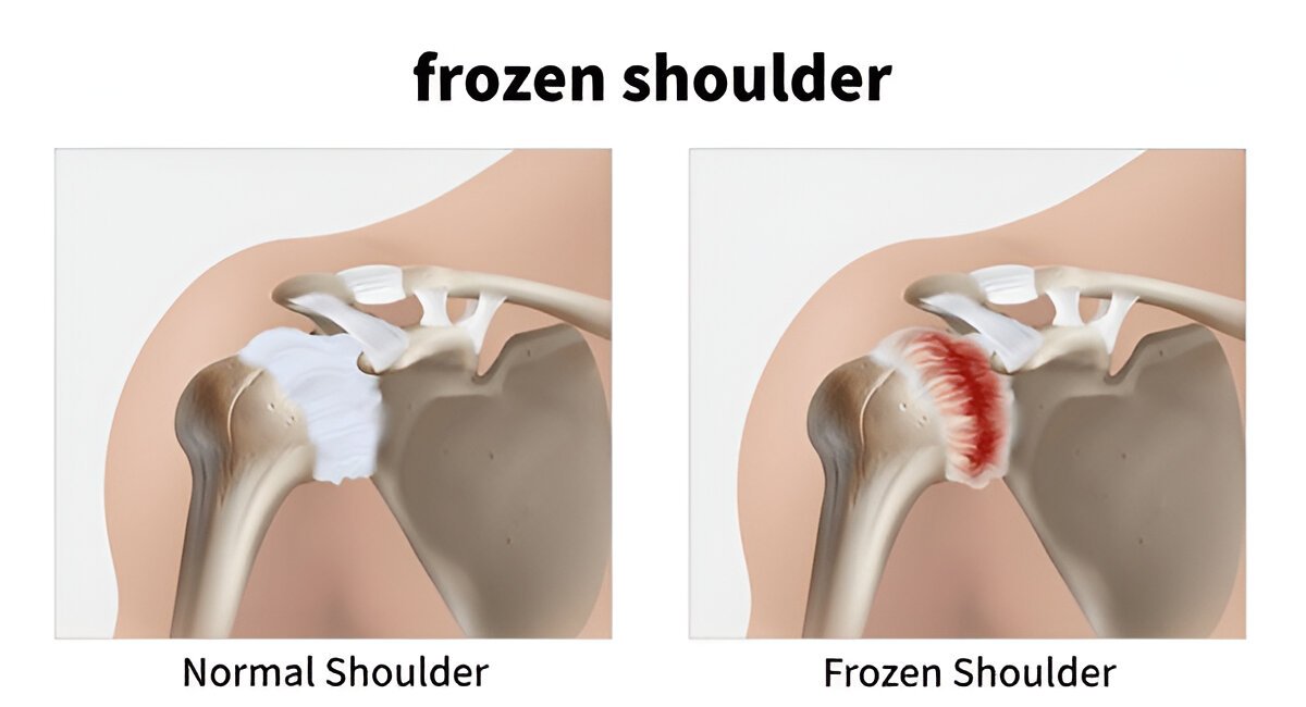 comparing a normal shoulder joint to a frozen shoulder