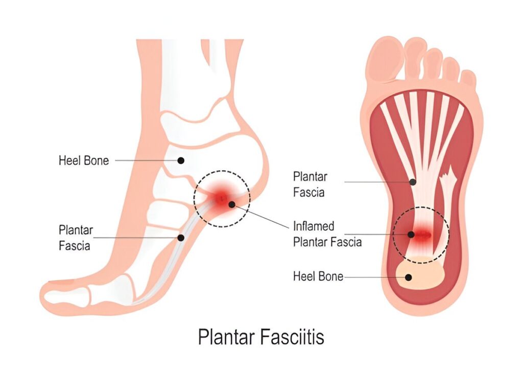 plantar fasciitis showing inflamed plantar fascia, heel bone, and foot anatomy