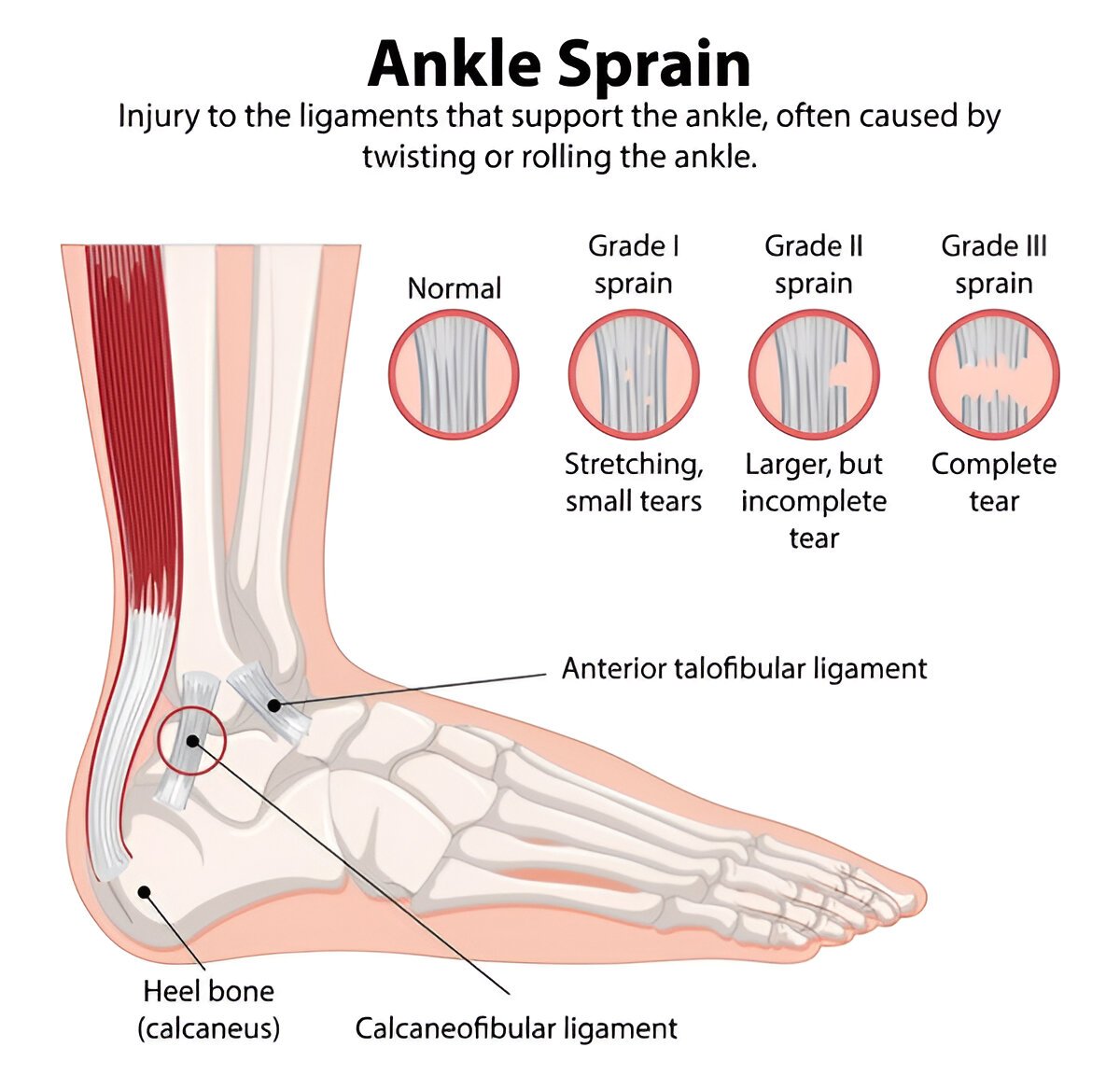 Ankle sprain diagram showing ligament injury levels 