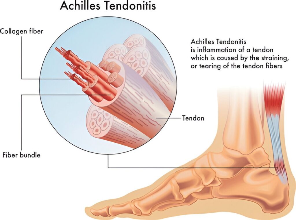 Achilles tendonitis showing tendon fibers, collagen bundles