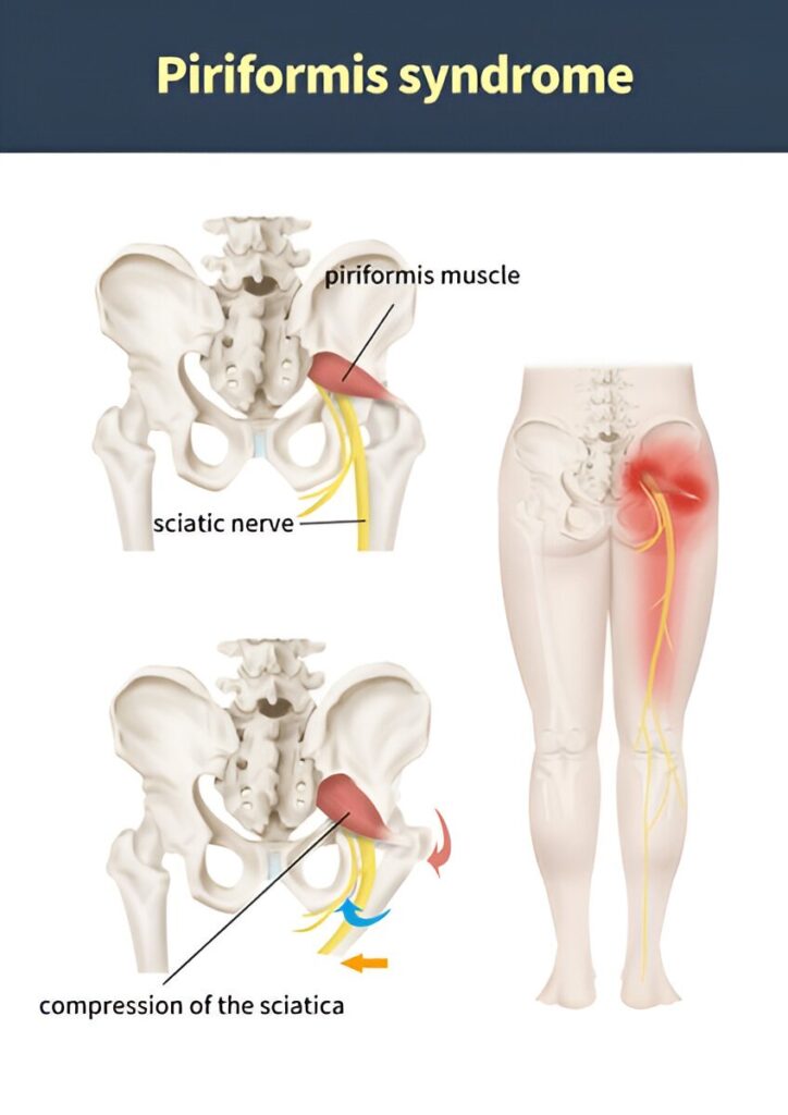 showing piriformis syndrome with compression of the sciatic nerve by the piriformis muscle