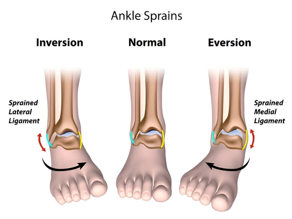 Ankle Sprain Ligament Damage