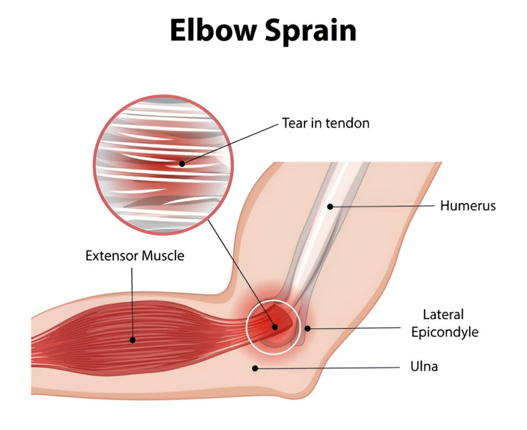 Types of elbow sprain physiotherapy