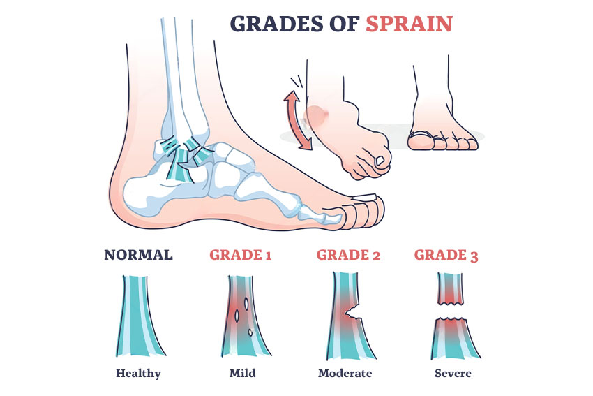 Grades of Sprain