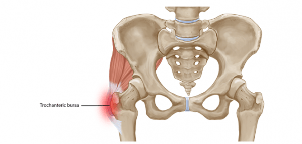 Hip (Trochanteric) Bursitis - Symptoms, Diagnosis, Treatment and ...