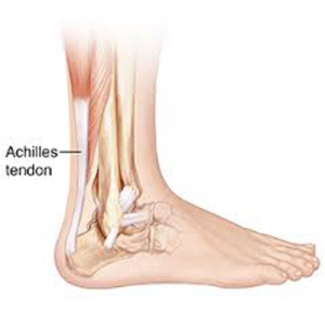 Achilles Tendinitis - Rapid Physiocare