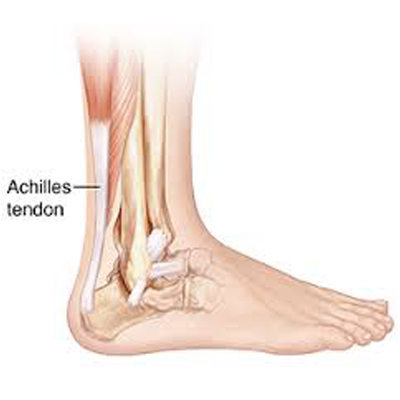 Achilles tendon pain hot sale out of nowhere