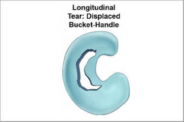 Bucket Handle Tear