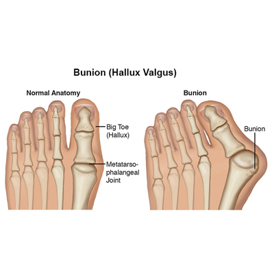 Bunion - Rapid Physiocare