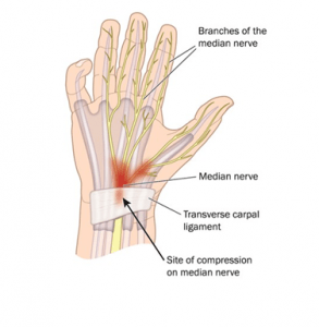 carpal tunnel syndrome