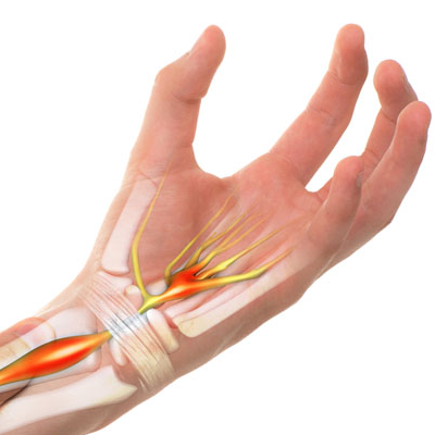 Illustration of Carpal Tunnel Syndrome symptoms affecting the wrist and hand.