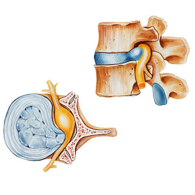 Disc herniation