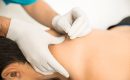 Physiotherapist performing dry needling therapy on patient's shoulder for pain relief
