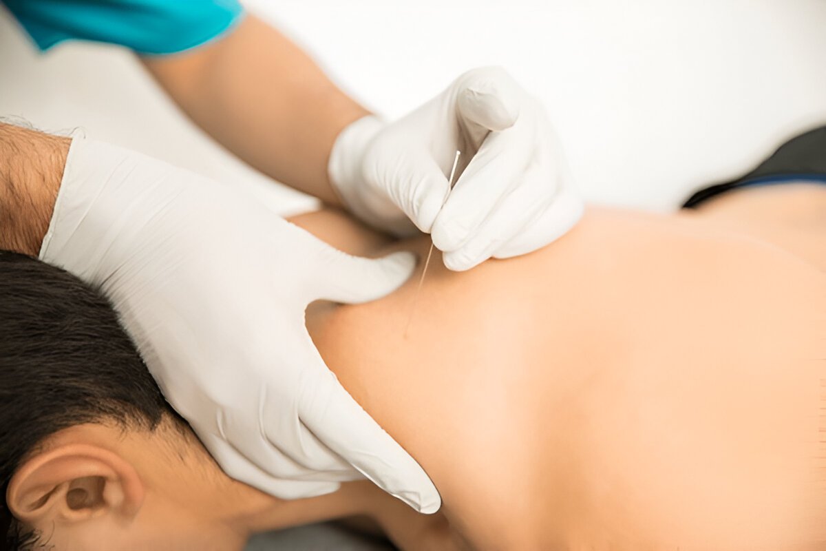 Physiotherapist performing dry needling therapy on patient's shoulder for pain relief