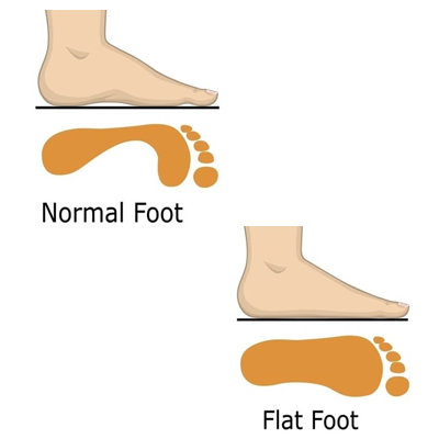 Flat feet - Rapid Physiocare
