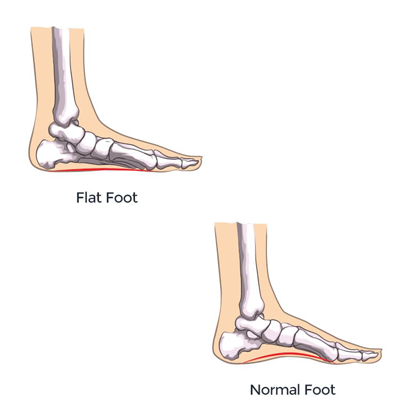 terapi flat foot