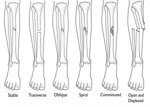 Tibia fractures in knee