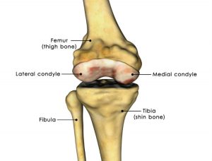 Femoral condyle fractures