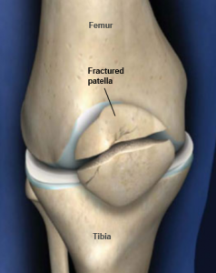 Knee fracture treatment