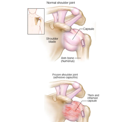 Person experiencing frozen shoulder, focusing on physiotherapy treatment.