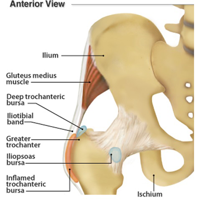 Exercise Tips for Hip (Trochanteric) Bursitis - Scolio-Pilates