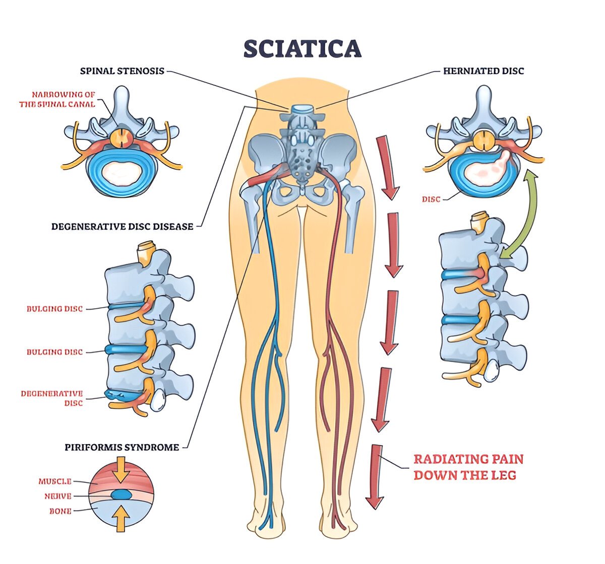 How Physiotherapy Helps Relieve Sciatica Pain