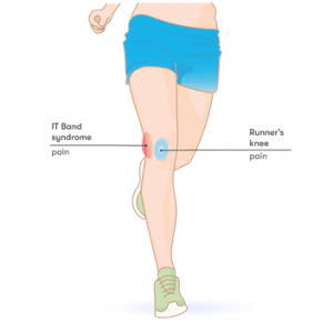 Runner's deals knee treatment