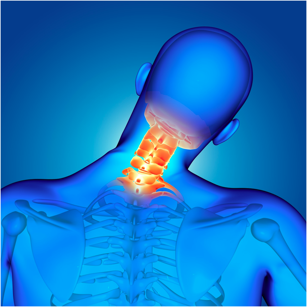 Illustration showing Cervical Spondylosis