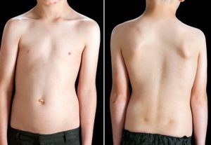 symptoms of Scoliosis in kids