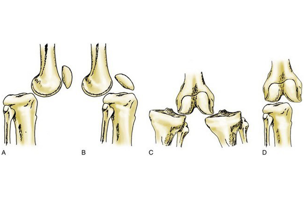 Knee Pain Treatment