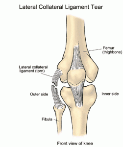 Lateral Collateral Ligament injury