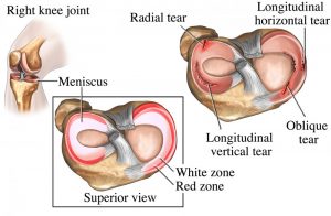 Meniscal Tear