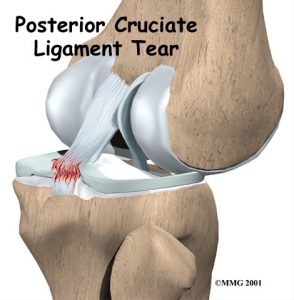 Posterior Cruciate Ligament injury