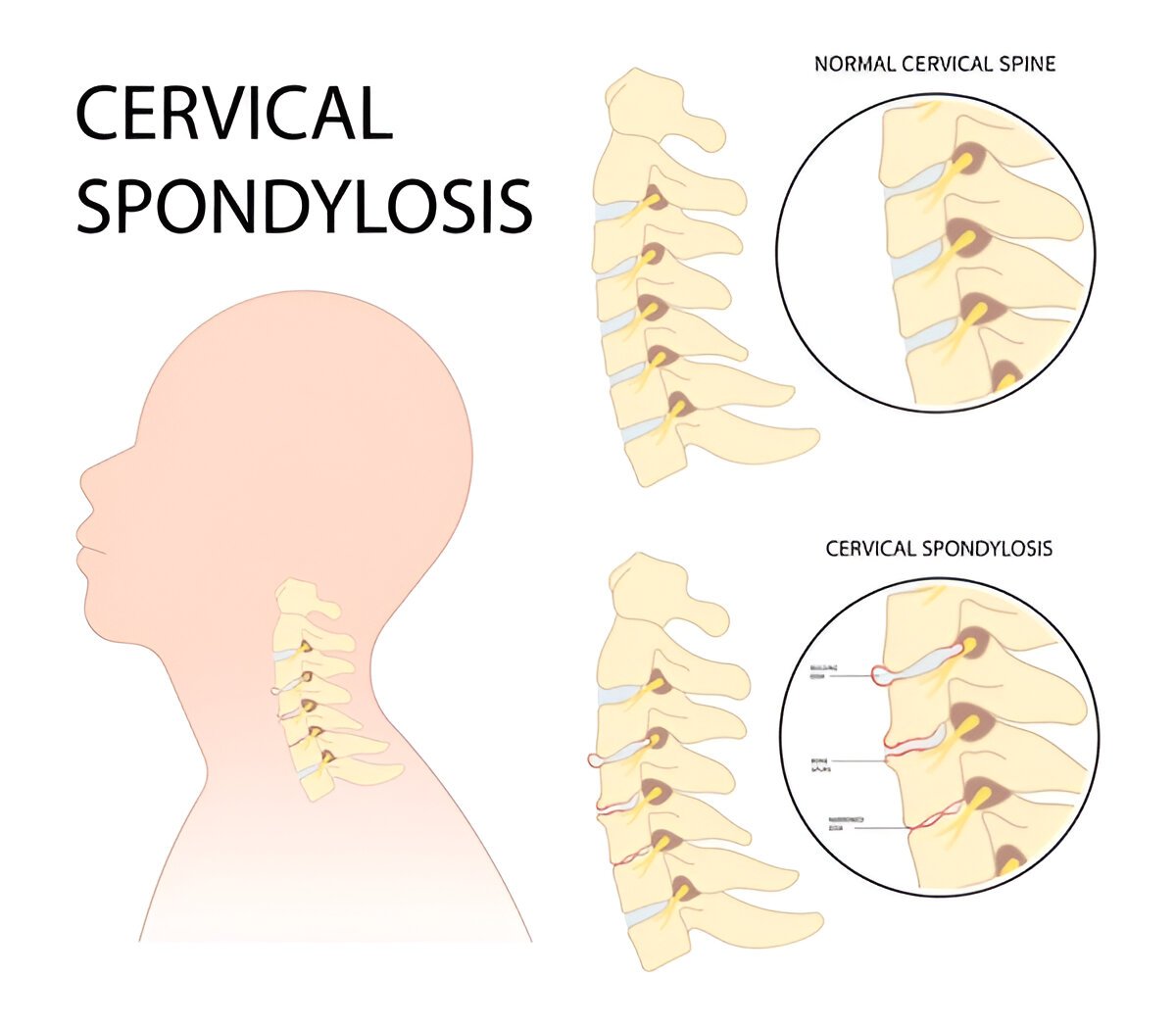 425192 Physiotherapy for Cervical Spondylosis