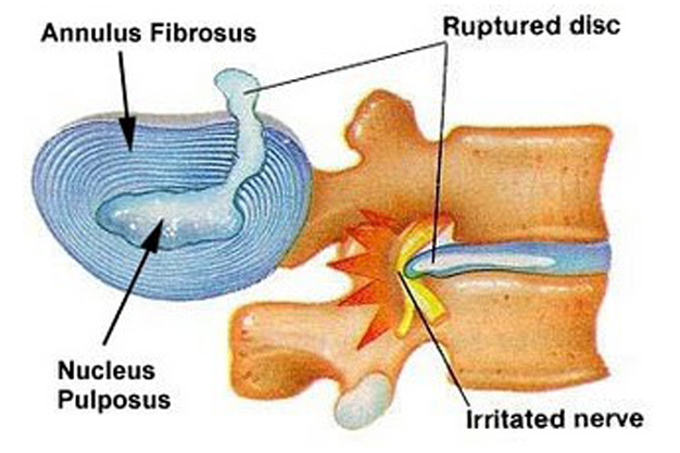 Cervical Radiculopathy