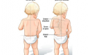 Scoliosis in Kids