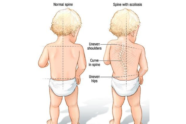 Scoliosis in Kids