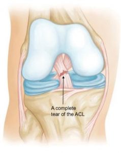 Anterior Cruciate Ligament injury