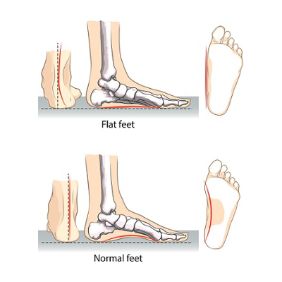 prevent from flat feet