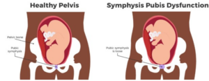 symptoms of symphysis pubis dysfunction