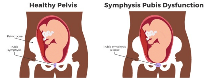 symphysis-pubis-dysfunction-treatment-in-singapore-rapid-physiocare