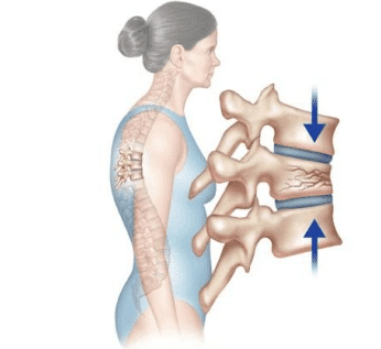 Physical Therapy in our clinic for Spinal Compression Fractures