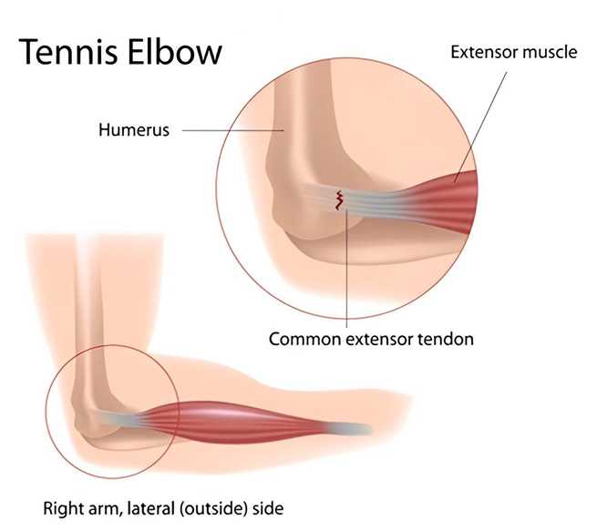 image Tennis Elbow Physiotherapy
